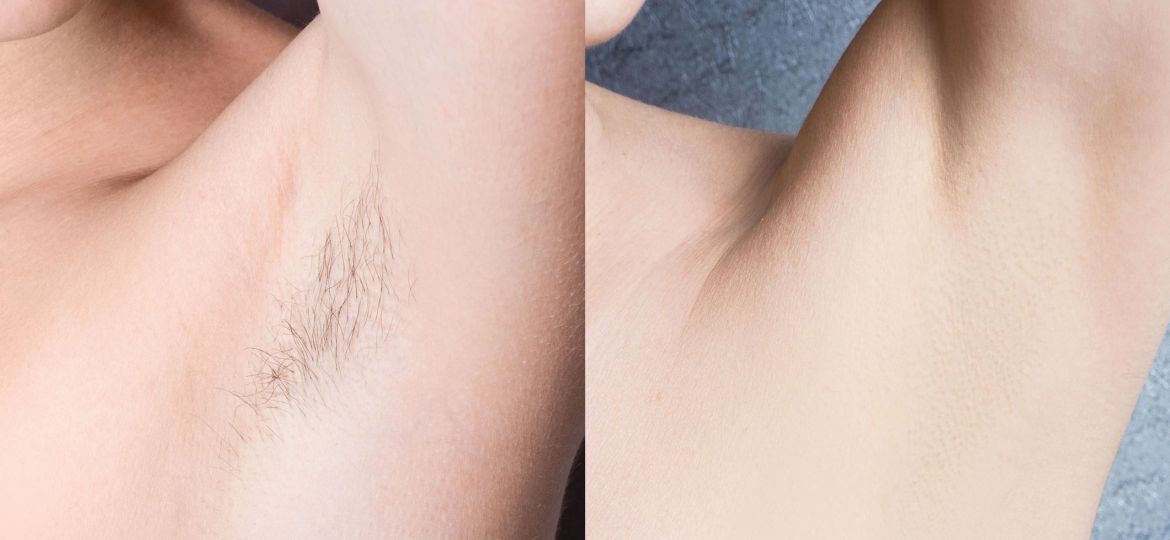 Women's,Underarm,Hair,Removal,Before,After,Concept